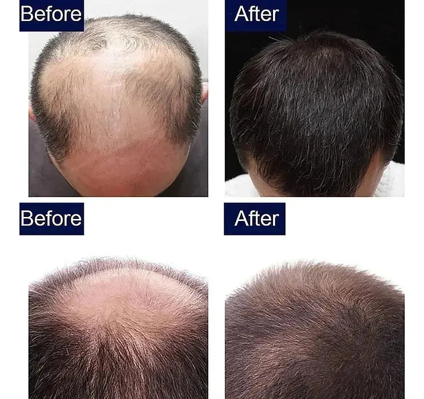 Ginger Hair | Oil for Hair Growth and Treatment of Baldness | Elegantiee