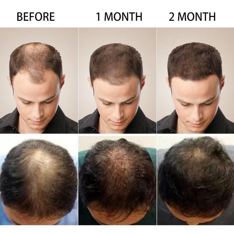 Ginger Hair | Oil for Hair Growth and Treatment of Baldness | Elegantiee