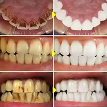 Penna Sbiancante Denti | SnowTooth | Compri 1 e ricevi 3 | Elegantiee