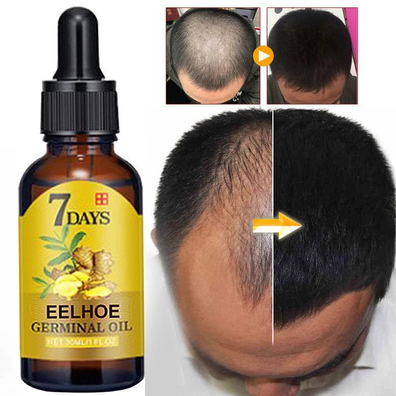 Ginger Hair | Oil for Hair Growth and Treatment of Baldness | Elegantiee